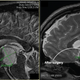 The tumor, full of fluid at left, empty at right. Radiation would be next.